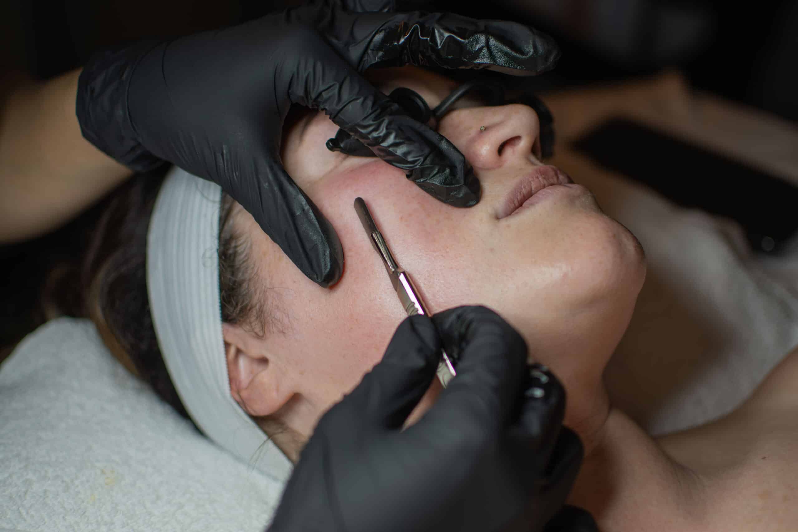 a woman has her face treated using the dermaplane technique