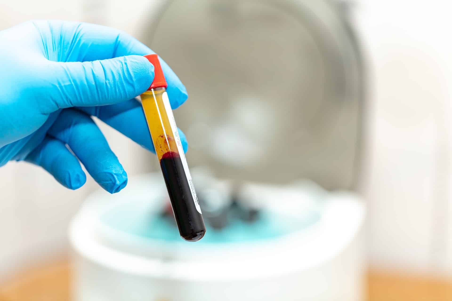 a gloved hand holds a tube of platelet rich plasma